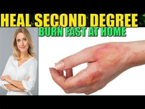 Try to do this quickly and gently, before the area swells. How To Heal A Burn Fast: 2nd Degree Burns Wound Care Home ...