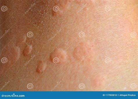 Itchy Hives Blister Of Allergy On Human Skin Stock Photo Image Of