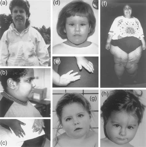 Imprinting Mutation Mechanisms In Prader Willi Syndrome The American