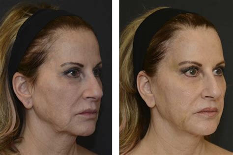 Are Thread Lifts The New Face Lift What You Need To Know The Healthy