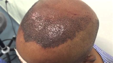Hairspray and mousse can be used one week after the transplant but should be washed off daily. Hair Transplant FUE Technique, Immediate Post Op Recipient ...
