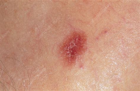 Melanoma Skin Cancer On Back