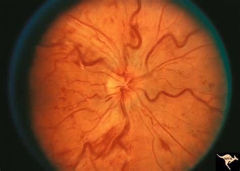 E03 Disc Swelling With Central Retinal Vein Occlusion Eccles Health