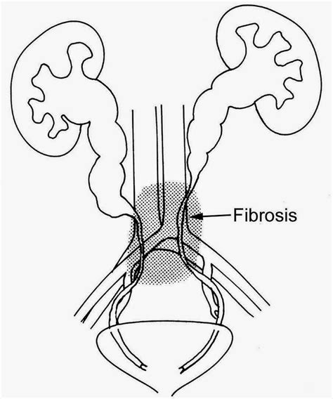 Brady Urology At Johns Hopkins Hospital Retroperitoneal Fibrosis Rpf