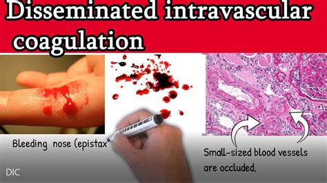 disseminated intravascular coagulation dic causes symptoms treatment and prognosis youtube