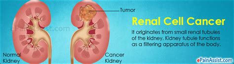 Learn what are the signs of kidney cancer are and common kidney cancer symptoms. Renal Cell Cancer: Treatment, Complications, Prognosis
