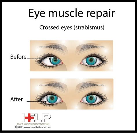 Eye Muscle Repair Eyes Muscle Repair