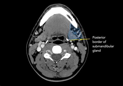 The Radiology Assistant Cervical Lymph Node Map 2023