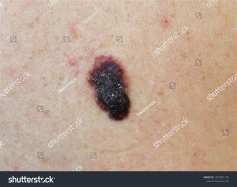 Melanoma Malignant Tumor Human Skin Stock Photo Edit Now 1201891150