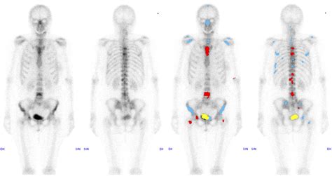 Computer Assisted Interpretation Of Planar Whole Body Bone Scans