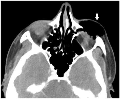 Orbital Blowout Fracture From Nose Blowing The Western Journal Of