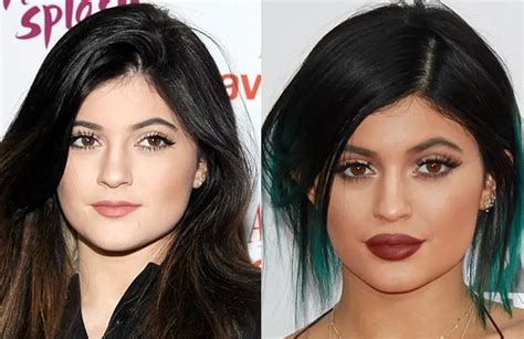 kylie jenner plastic surgery before and after celebie