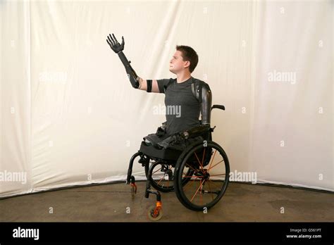 Alex Lewis Who Lost His Arms And Legs To Toxic Shock Syndrome Wears A Prosthetic Arm Developed