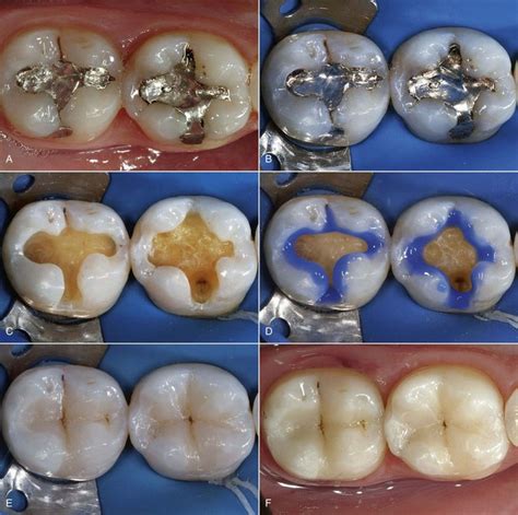 9 Direct Composite Restorations Pocket Dentistry