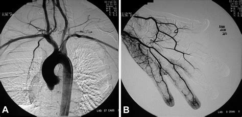 Aortic Arch Angiogram Medical