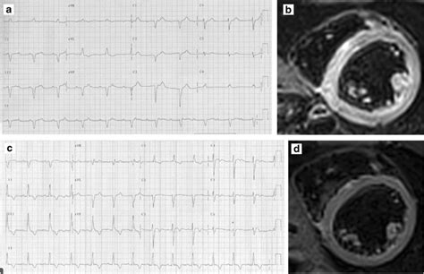 Serial Electrocardiograms And Cmr Imaging Of A Young Athlete With Acute