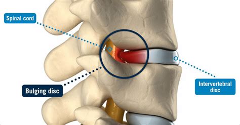 Bulging Disc Usa Spine Care Laser Spine Surgery