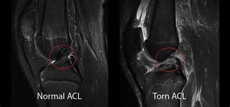 Acl Injuries Atlanta Bone And Joint Specialists