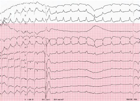 Current Management Of Focal Atrial Tachycardia In Children