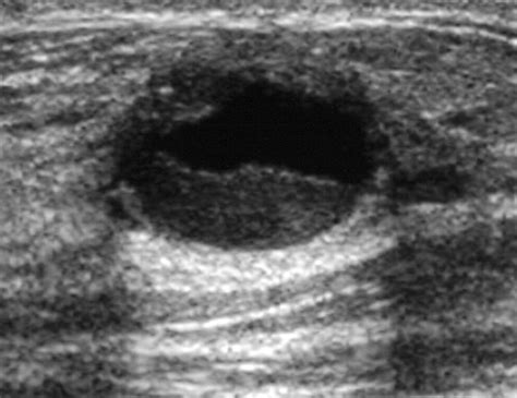 Complicated Breast Cysts On Sonography Academic Radiology