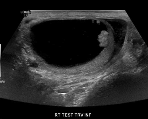 A 58 Year Old Man Presenting With A Cystic Neoplasm Of The Testis Renal And Urology News