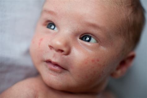 Baby Acne Medical Pictures Info Health Definitions Photos