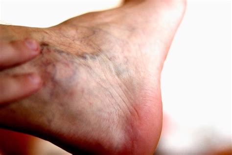 Varicose Veins In Feet Naples Cardiac And Endovascular Center