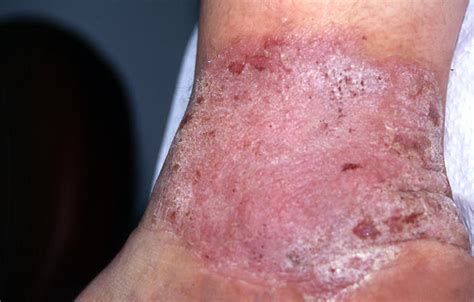 Dermatitis Ekzema Eczema Picture Hellenic Dermatological Atlas