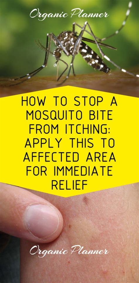 How To Stop A Mosquito Bite From Itching You Can Apply This To