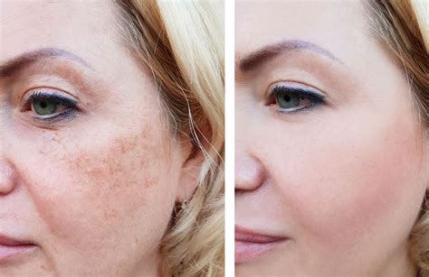 Skin Pigmentation Treatment Adelaide Your Trusted Local Clinic