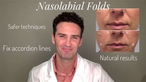 Nasolabial Folds And Accordion Lines A Tutorial Youtube