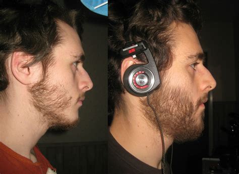 Again, this is just before and after the application of minoxidil, not necessarily before and after the minoxidil journey. Minoxidil beard forum - BeardStylesHQ