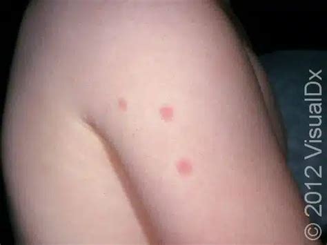 Bedbug Bite Condition Treatments And Pictures For Infants Skinsight
