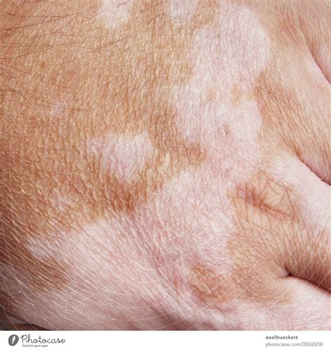 Vitiligo Or White Spot Disease A Royalty Free Stock Photo From Photocase