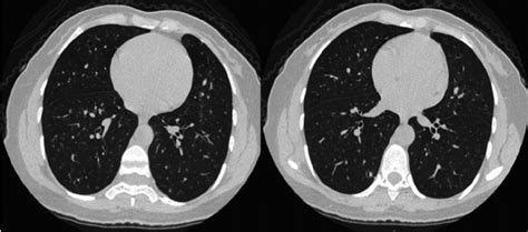 Two Cross Sectional Images From Chest Computerized Tomography Ct Scan