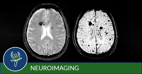 Neuroimaging Capitol Imaging Services