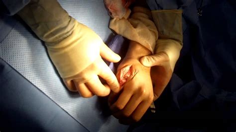 Breaking up with someone will be difficult, no matter how much you assure yourself that things will go smoothly. Hand Surgery (Removing Scar Tissue) Boxer's Break - YouTube