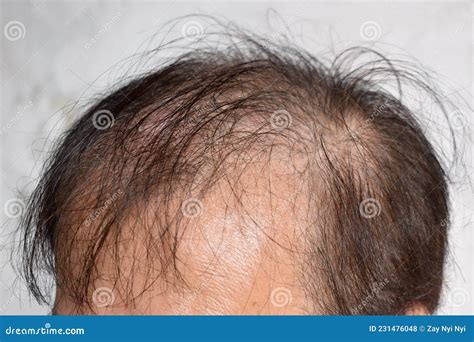 Thinning Or Sparse Hair Male Pattern Hair Loss In Asian Elder Man