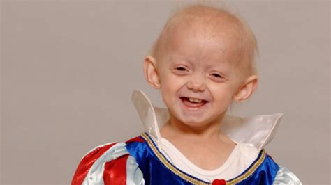 Progeria Hutchinson Gilford Progeria Syndrome Causes Symptoms