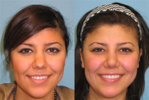 Nose Surgery Before And After Photos Patient 39 San Francisco Ca