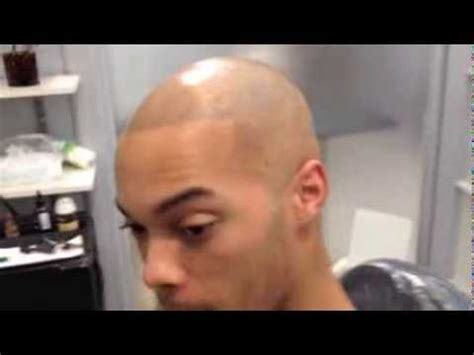 Round, oval, heart, and triangular hair density : hair simulation- 3 year update Mr CR-hair follicle ...