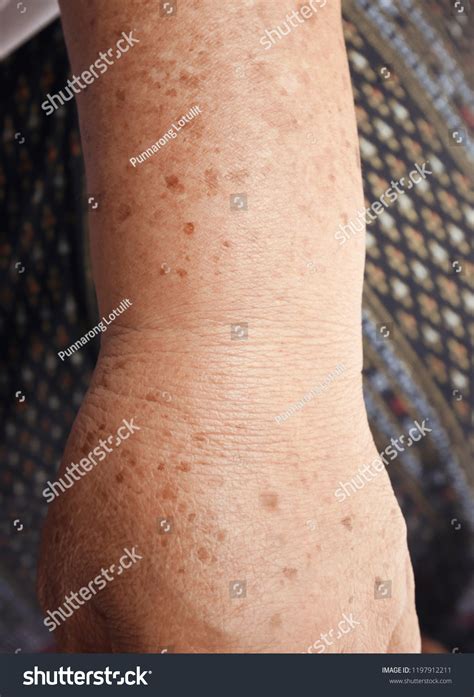 Dark Spots On Skin On Arm Stock Photo 1197912211 Shutterstock
