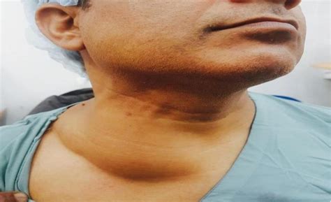 Figure 1 From A Case Report Of Giant Anterior Neck Lipoma Semantic