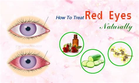 28 Tips How To Treat Red Eyes At Home Without Eye Drop