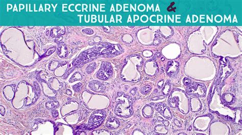 Papillary Eccrine Adenoma Tubular Apocrine Adenoma Dermpath In 5