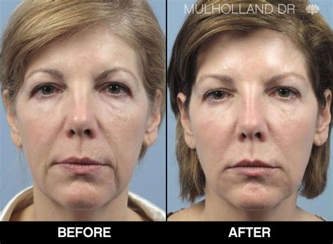 A full face ablation with dr. Toronto Fractional CO2 Laser - Laser Skin Resurfacing | TPS