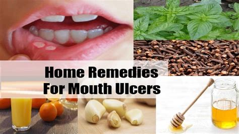 Although there is no cure for down syndrome condition, you can manage it through a supportive therapy. Mouth Ulcers: Amazing Natural Home Remedies to Get Rid of ...