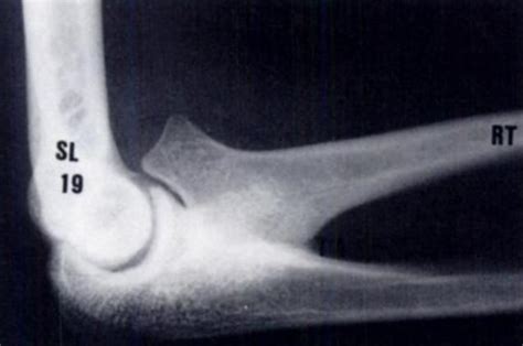 Congenital Radial Ulnar Synostosis Hand Orthobullets