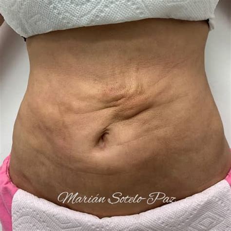 Fibrosis After Lipo Treating Imperfections After Liposuction