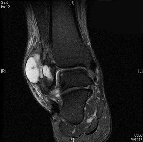 Intraosseous Ganglion Of The Ankle A Case Report The Foot And Ankle